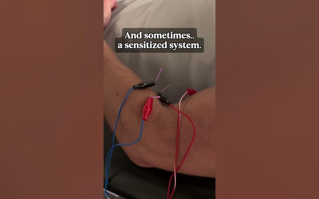 Dry needling needles and electrical leads on a patient's upper back and shoulder, from Dr. Emily Warren's social video